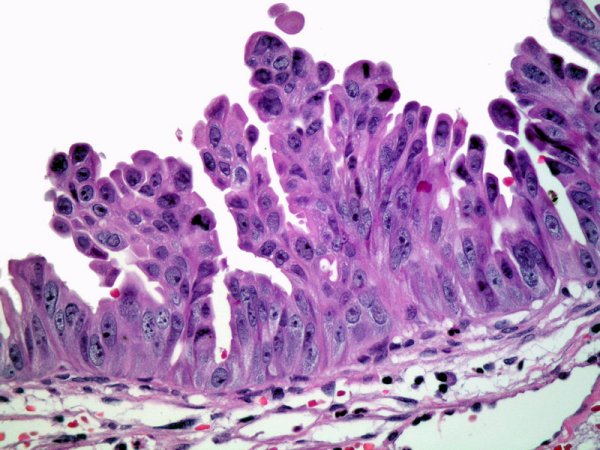 Carcinoma In Situ de la Vesícula biliar - <div style=